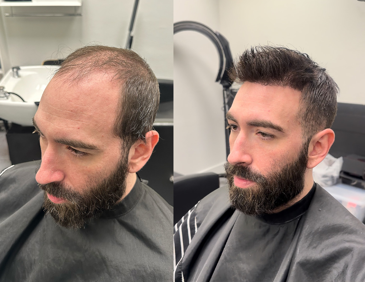 Before-and-after hair system example — JM Barber Co., Lake Park, Florida